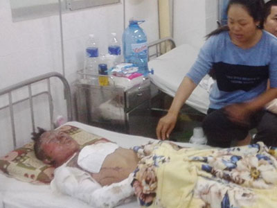 Vừa rút xăng vừa hút thuốc, nam thanh niên bị bỏng nặng