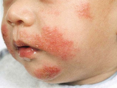 Cách nhận biết trẻ bị dị ứng sữa