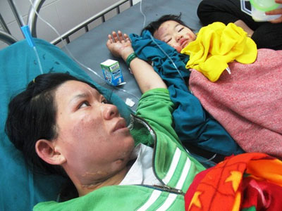 Bồng con nấu ăn, 2 mẹ con bị bỏng nặng