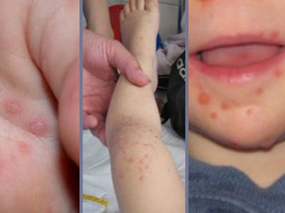 Hà Nội: Xuất hiện 5 ổ dịch tay chân miệng
