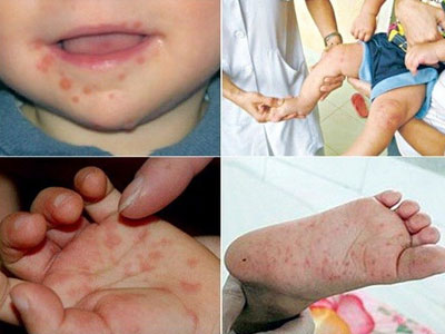 Có thể bị bệnh tay chân miệng nhiều lần?