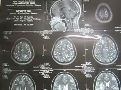 Kinh hoàng giun, sán ăn lục phủ ngũ tạng người