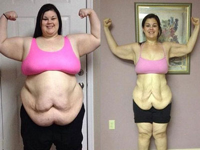 Phải phẫu thuật cắt da thừa vì giảm cân gần 100 kg