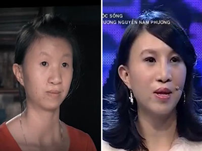 Ngỡ ngàng diện mạo mới của cô gái mang dị tật sứt môi hở hàm ếch