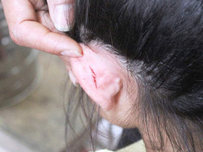 Cô giáo mầm non kéo tai làm trẻ bị thương