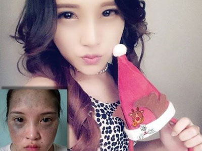 9x Hải Phòng mặt chàm thay đổi hoàn toàn nhờ phẫu thuật thẩm mỹ