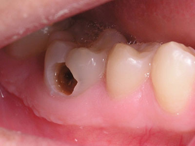 Răng hỏng gây hại đến cơ thể như thế nào?