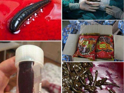 Thực hư ca phẫu thuật toàn đỉa tại BV Bạch Mai
