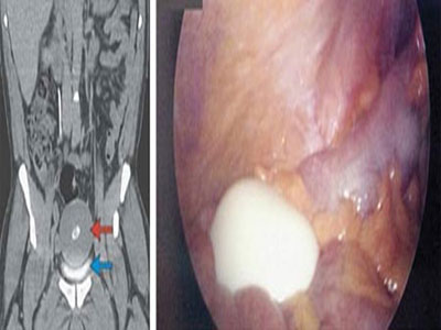 Phát hiện "quả trứng luộc" tồn tại 20 năm trong bụng người