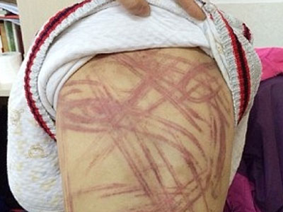 Cộng đồng mạng phẫn nộ cậu bé 9 tuổi bị bố mẹ nuôi đánh dã man