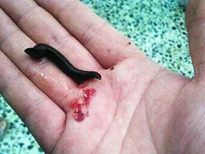 Kinh hãi đỉa chui cổ họng bé trai vì uống nước ao