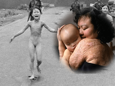 "Em bé napalm" nhớ lại ngày dội bom kinh hoàng