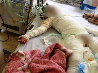 Bé gái 5 tuổi bỏng toàn thân do than văng vào người