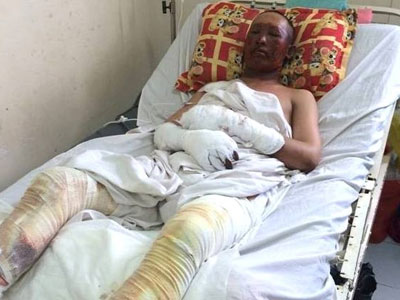 Nổ lò nung, 2 công nhân bị thép văng vào người