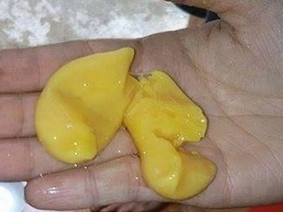 Trứng vịt có lòng trắng bám “như đỉa” gây hoang mang