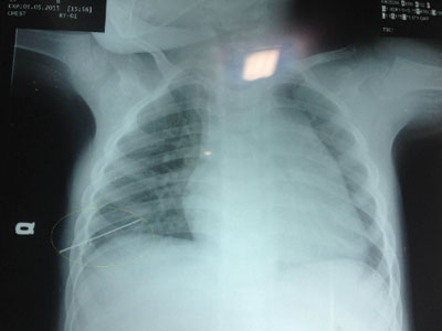 Bé 3 tuổi bị thủng phổi vì kim đâm xuyên ngực