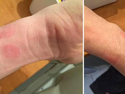 Người dùng bị dị ứng da khi đeo Apple Watch