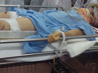 Nữ sinh lớp 8 rơi từ tầng 3 xuống đất tiên lượng khó qua khỏi
