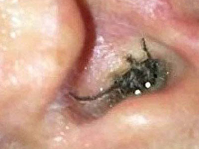 Hốt hoảng vì nhện làm tổ trong lỗ tai người