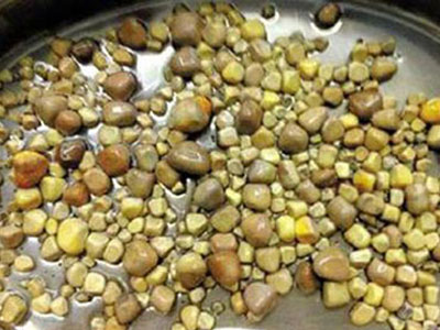 Phẫu thuật lấy 420 viên sỏi thận ra khỏi cơ thể bệnh nhân