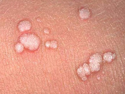 Nghiệt ngã chuyện ô sin bị sùi mào gà lây bệnh cho cả ông bà chủ