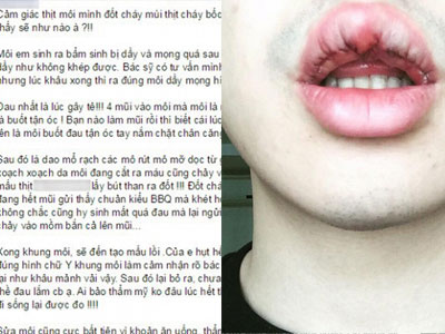 Chàng trai Hà Nội chịu đau đớn "chết đi sống lại" để thẩm mỹ môi trái tim