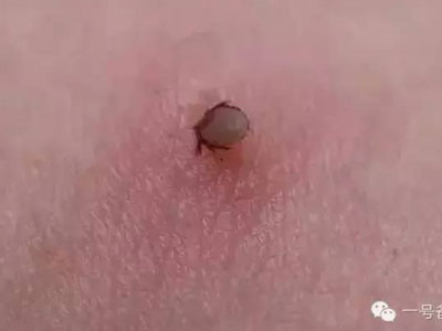 Kinh hãi con bọ ve "đào hầm" vào lưng bé trai 5 tuổi
