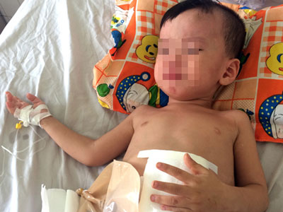 Bé 3 tuổi phải cấp cứu sau cú đạp của cha dượng