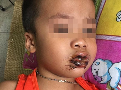 4 trẻ mầm non nhập viện vì ăn nhầm bột thông cống