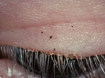 Gắp 20 con rận găm trong mí mắt người phụ nữ