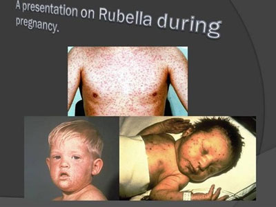 Rubella - Căn bệnh không thể xem nhẹ