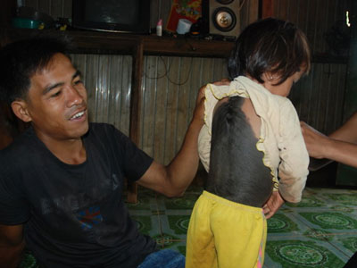 Cô bé 4 tuổi có bộ lông dày suýt bị chôn sống