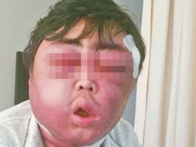 Mặt sưng phồng như quả bóng chỉ vì một vết... muỗi đốt