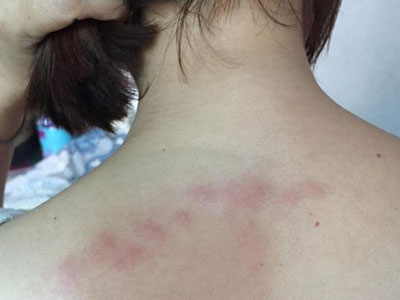 Rệp hút máu người xuất hiện ở Sài Gòn
