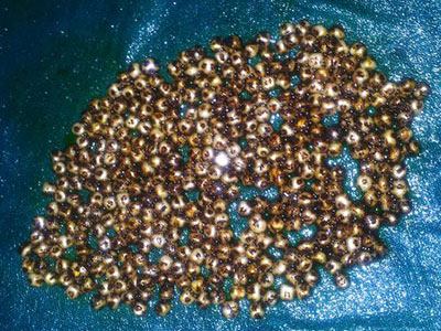Bác sĩ tê tay khi gắp 360 viên sỏi trong túi mật bệnh nhân