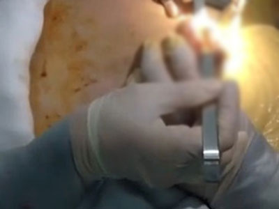 Thực hư về clip chất dịch vàng trào ra "ồ ạt" từ ngực thẩm mỹ hỏng