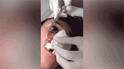 Môi sưng to như quả nho vì bị giòi 2cm đào hang làm tổ ở trong
