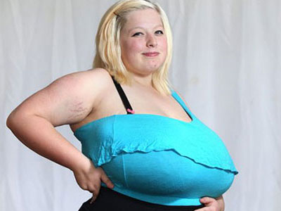 Liên tục bị đau lưng vì vòng một nặng gần 10 kg