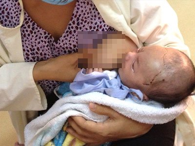 Bé trai bị đâm xuyên sọ ăn khỏe sau 3 ngày trở về nhà