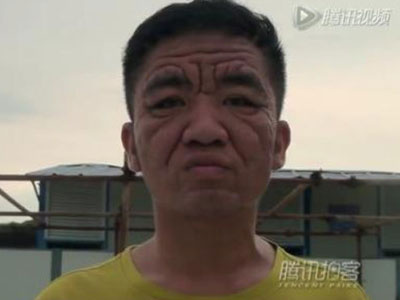 Bệnh lạ khiến chàng trai 30 tuổi già như ông cụ
