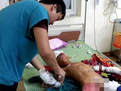 Đồ chơi phát nổ, bé trai 9 tuổi bị thương nặng