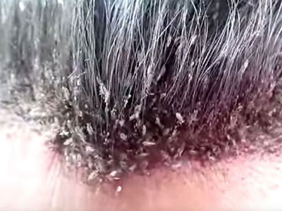Đoạn video về chấy rận trên tóc khiến ai cũng phải nổi da gà