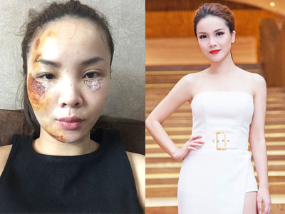 Sốc với khuôn mặt Yến Trang khi gặp tai nạn giao thông