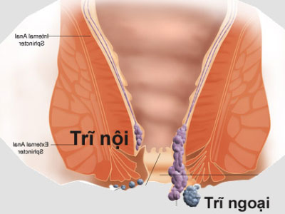 Cảnh báo 30 - 50% người Việt mắc căn bệnh để lâu dễ thành ung thư