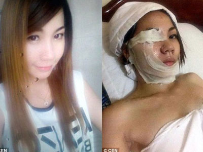 Tạt a-xít người yêu cũ, cô gái tự đốt cháy mặt mình