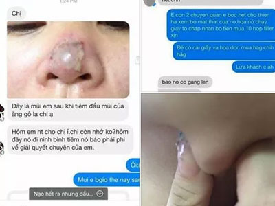 Tràn lan mốt làm đẹp tiêm Filler và hiểm họa khi tiêm phải chất dởm