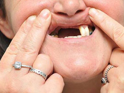 Tẩy trắng răng giá rẻ, rụng luôn răng cửa