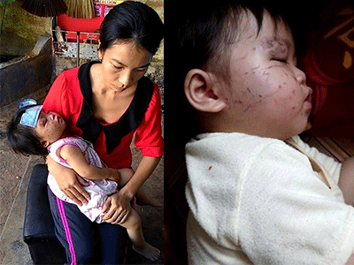 Bé 1 tuổi bị cào cấu chi chít: Người mẹ bức xúc trước thái độ thờ ơ của nhà trường