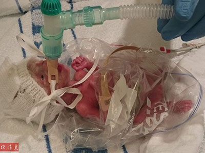 "Cô bé hạt tiêu" nặng 0,5kg sống sót kỳ diệu nhờ túi đựng bánh mì