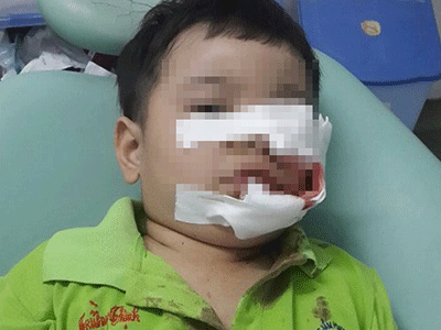 Dồn dập trẻ bị chó cắn nát mặt: Nguy hiểm rình rập